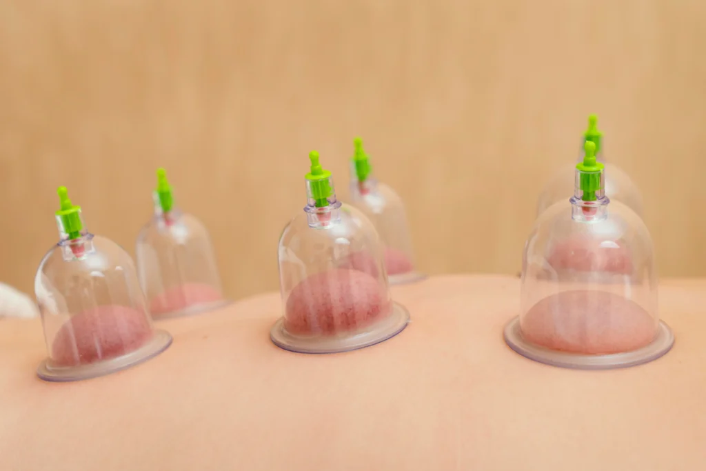 cupping